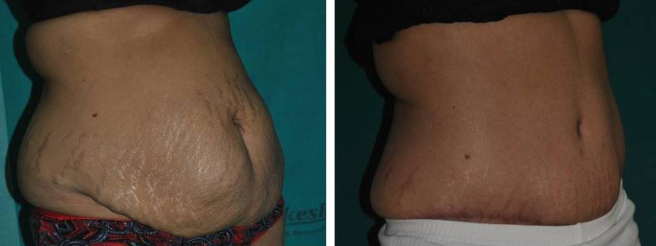 Tummy tuck with ventral hernia repair